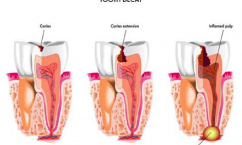 endodontic-therapy-root-canals