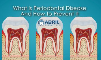 What is Periodontal Disease And How to Prevent It
