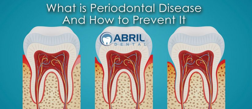 What is Periodontal Disease And How to Prevent It